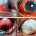 Type 2 Reaction: Acute Episcleritis and Scleritis