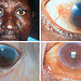 Massive Bacillary Infiltration: Ocular Infiltration