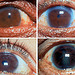 Massive Bacillary Infiltration: Ocular Atrophic Changes 