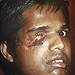 Lesão causada por um foguete. Sri Lanka