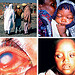 Examination for Eye Disease in Children<