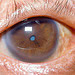 A mature cataract behind a typical pinpoint pupil