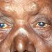 Leprosy and cataract
