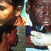 Paucibacillary Leprosy and Multibacillary Leprosy 