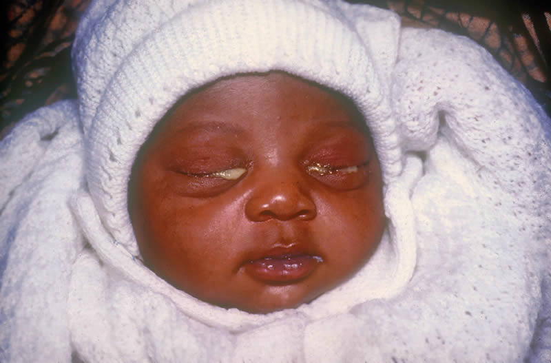 comment nettoyer les yeux d'un bébé qui a une conjonctivite