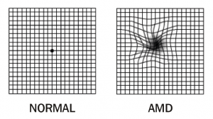 The Amsler Grid For Macular Degeneration - Millennium Eye Center