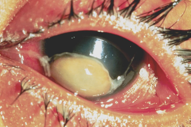 Community Eye Health Journal The Eye Signs Of Vitamin A Deficiency