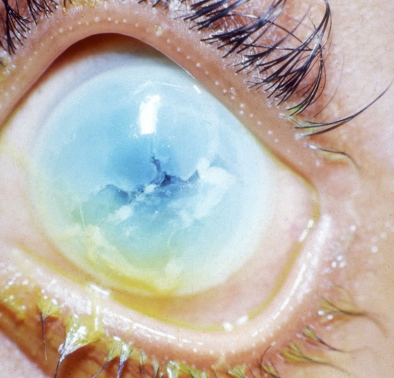 Community Eye Health Journal The Eye Signs Of Vitamin A Deficiency