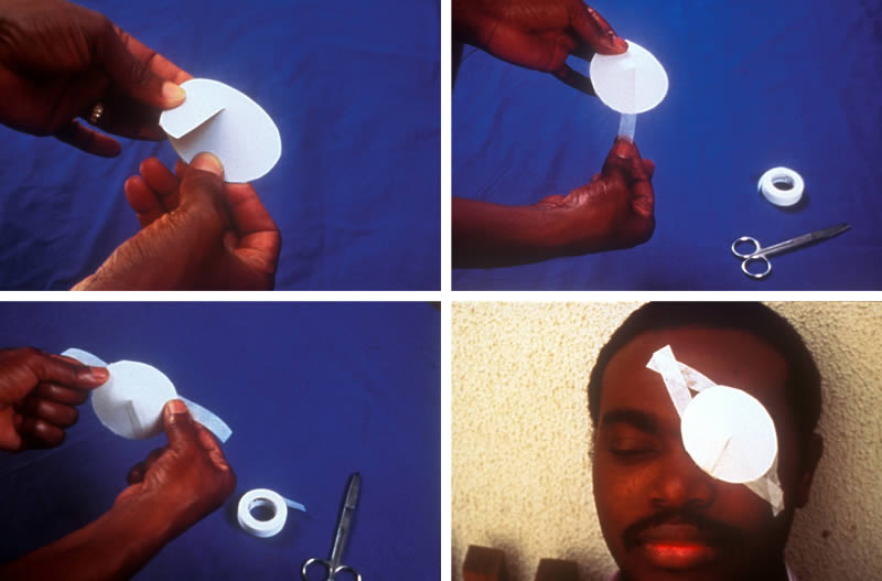 comment appliquer une coque oculaire