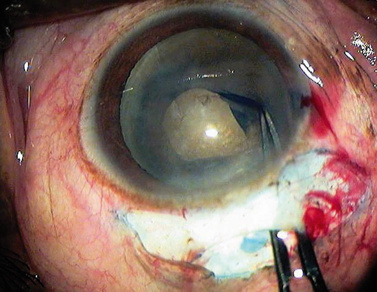 Community Eye Health Journal » Small incision cataract surgery: tips for  avoiding surgical complications
