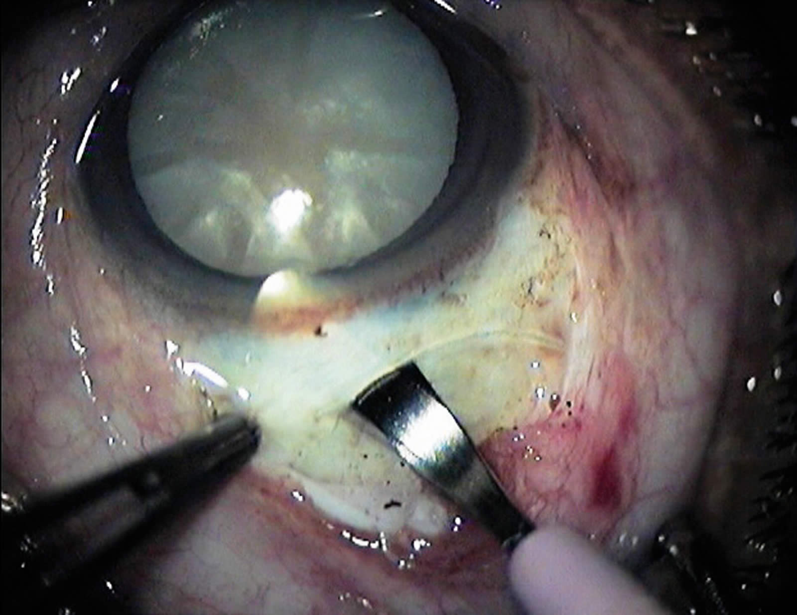 Community Eye Health Journal » Small incision cataract surgery: tips for  avoiding surgical complications