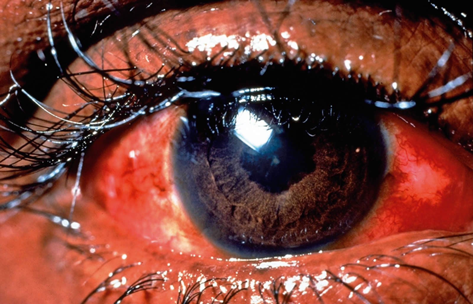 Community Eye Health Journal » The red eye – first at the primary