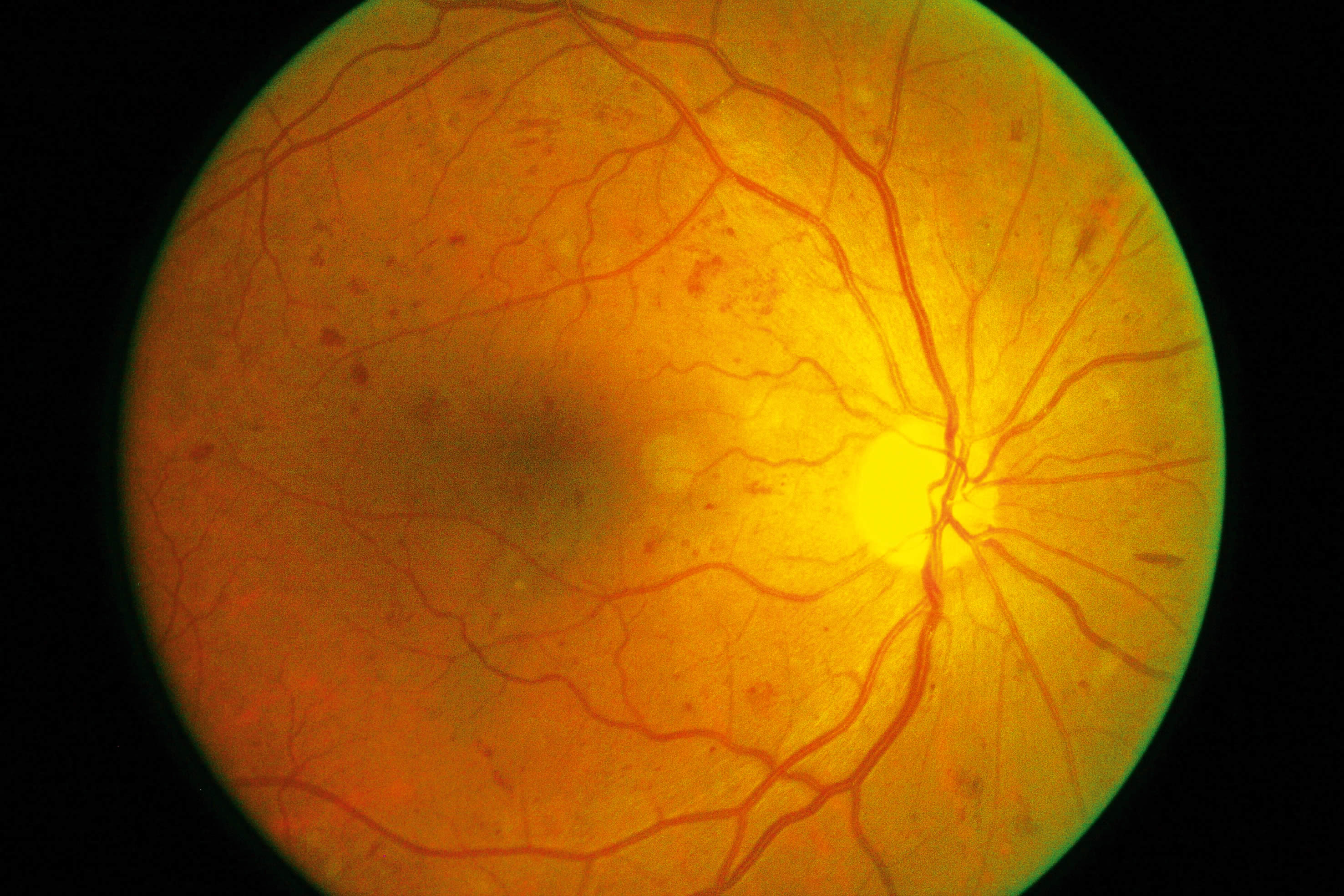 Дефекты сетчатки. Непролиферативная диабетическая ретинопатия. Атеросклеротическая ретинопатия. Диабетическая ретинопатия сетчатки. Диабетическая ретинопатия глаз.