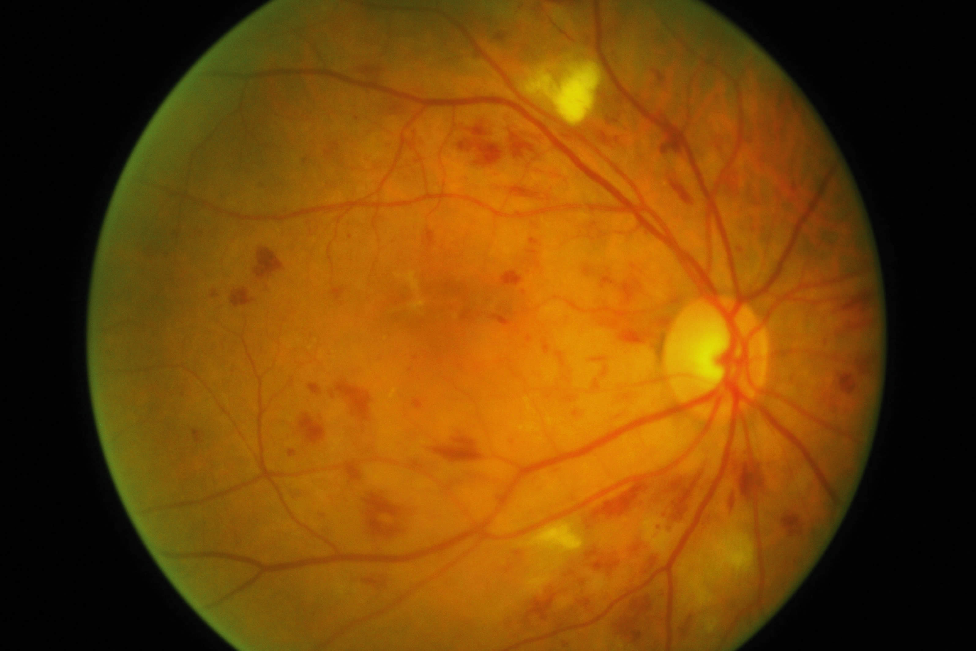 Сетчатки обоих глаз. Гипертоническая ретинопатия. Анемическая ретинопатия. Периферическая неоваскуляризация сетчатки. Гипертоническая ретинопатия дистрофия.