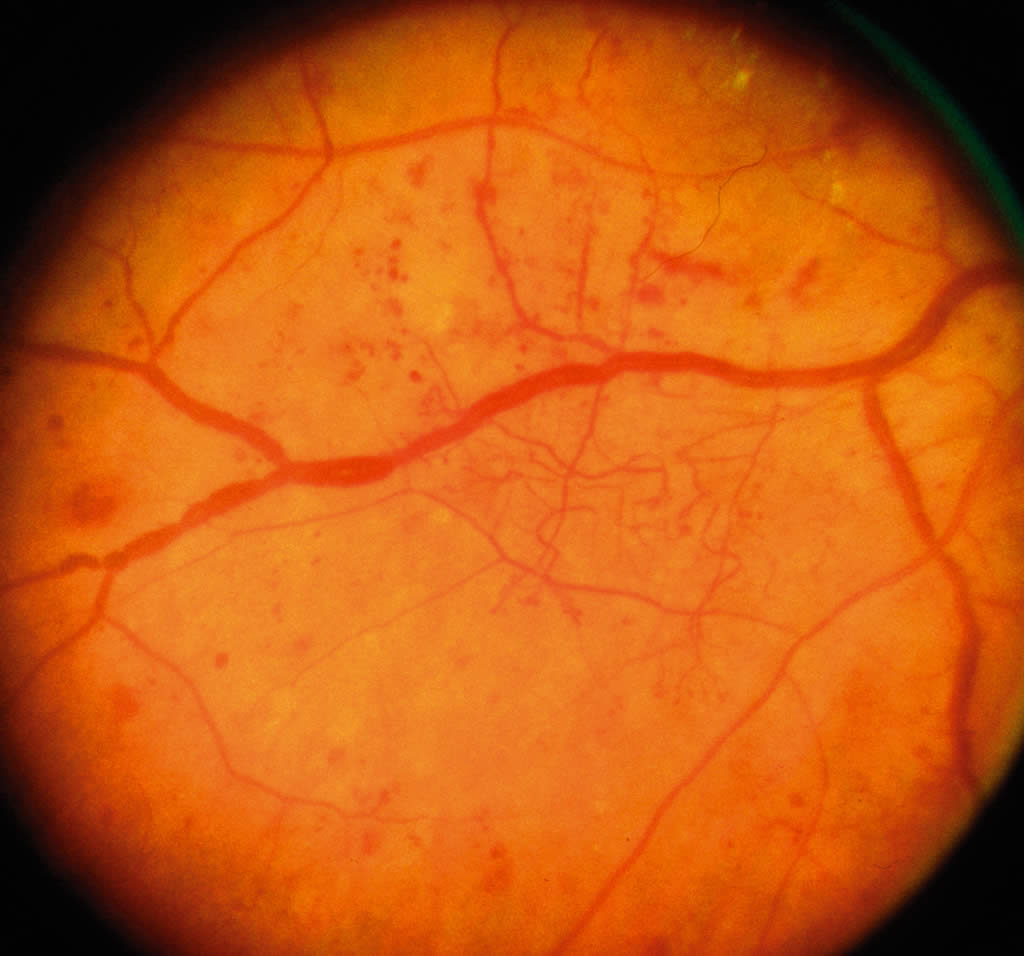Воспаление сетчатки. Сетчатка непролиферативная ретинопатия. Ретинопатия непролиферативная стадия.