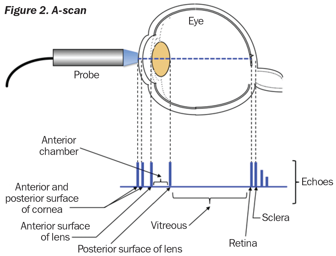Ambicioso modelo nitrógeno Community Eye Health Journal » Caring for A- and B-scans