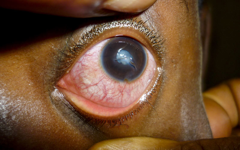 A 10-year-old with corneal laceration and traumatic cataract after a stone hit him in the eye. CAMEROON. Faustin Ngounou