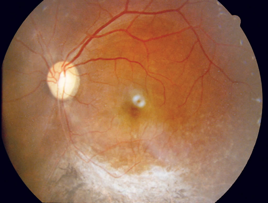 cmv retinitis