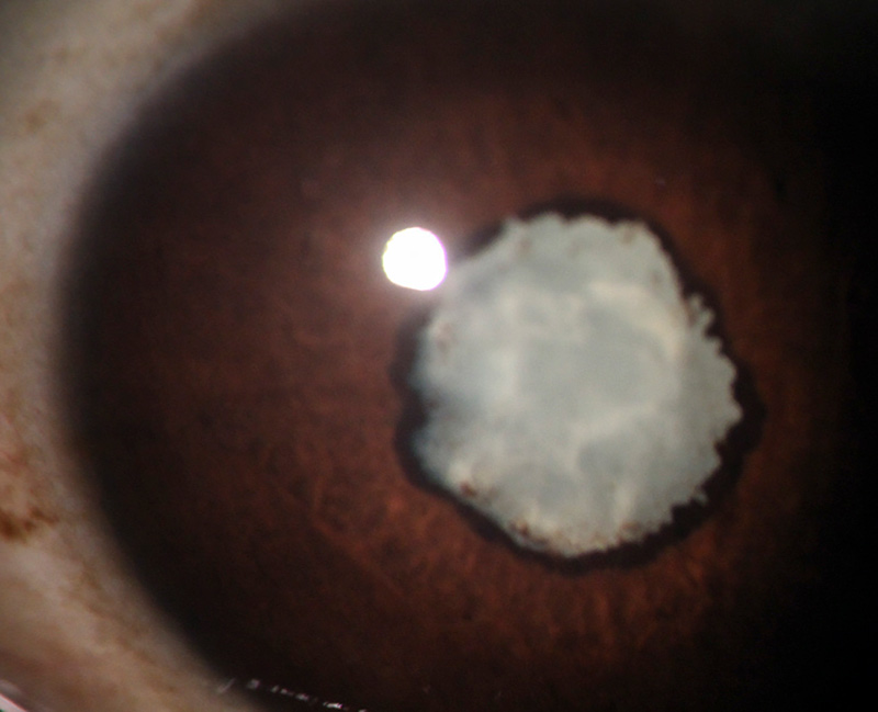 Photographie en gros plan de l’iris d’un œil présentant une cicatrice dense et blanche et un bord pupillaire irrégulier.