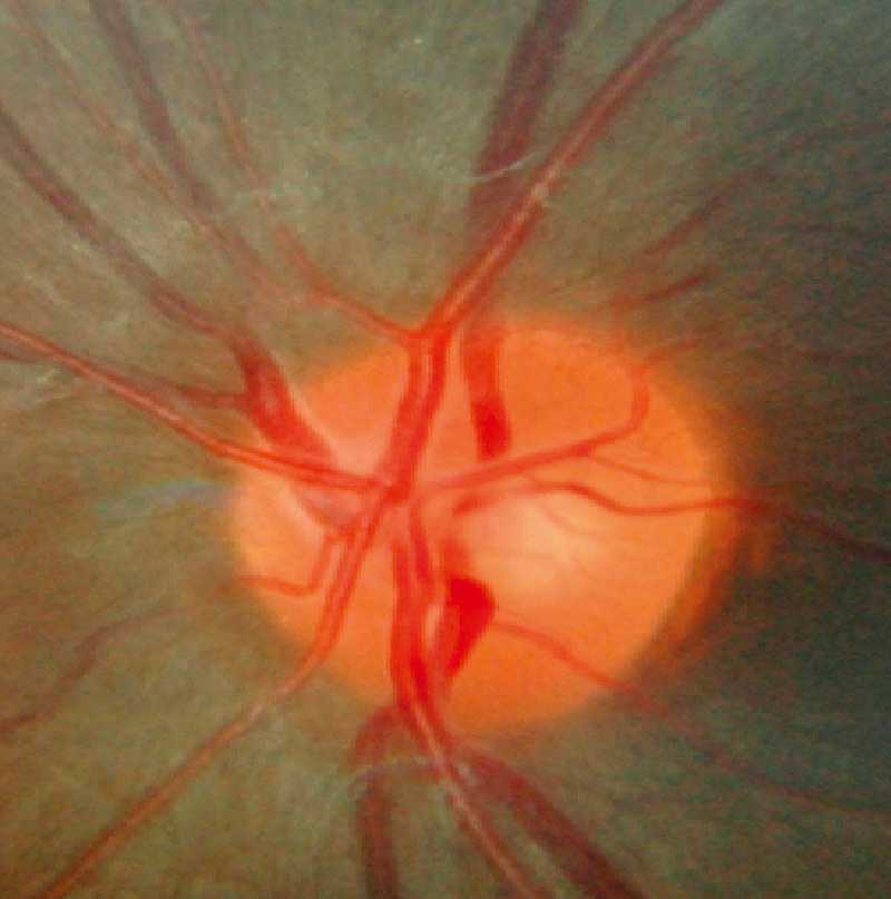 Close up image of an optic nerve