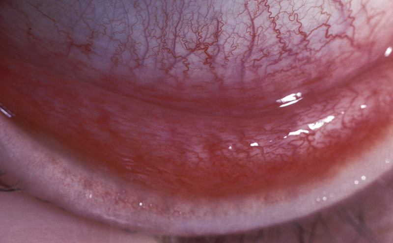 Photographie en gros plan montrant une conjonctive tarsale présentant des follicules, qui sont typiques d’une conjonctivite virale