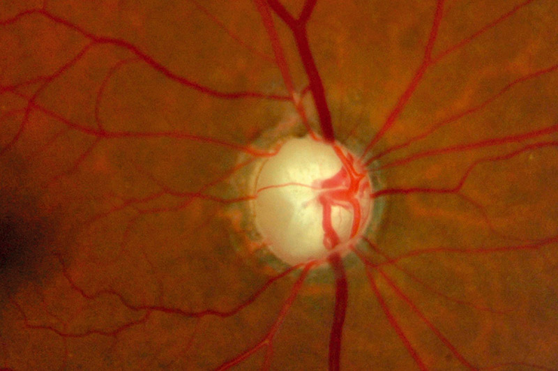 Cliché de fond d’œil d’un patient présentant un glaucome.