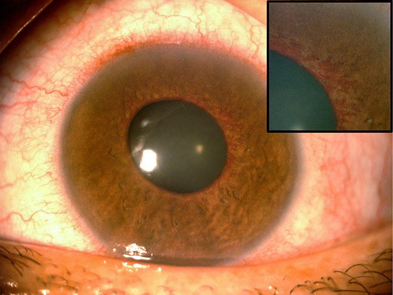 close up image of the front of an eye with a smaller image of a zoomed-in image inserted in the top right corner