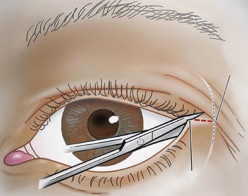 Illustration (drawing) of the procedure