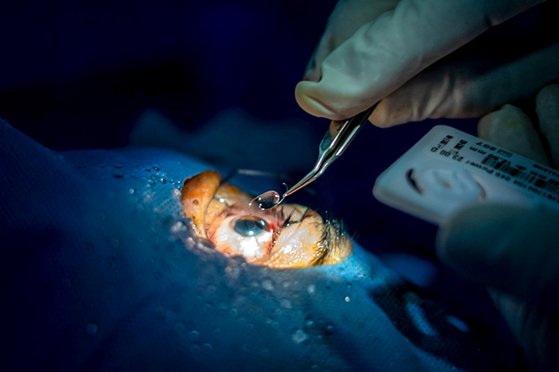 Surgeon inserting an intraocular lens