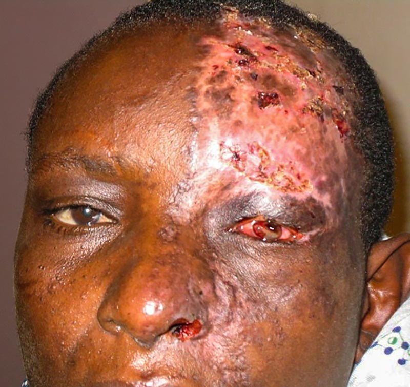 Photographie de la tête d’un patient ayant un ophtalmique, sur laquelle on ne voit pas la partie du visage située sous le nez. Le patient a un zona et un ulcère de cornée perforé.