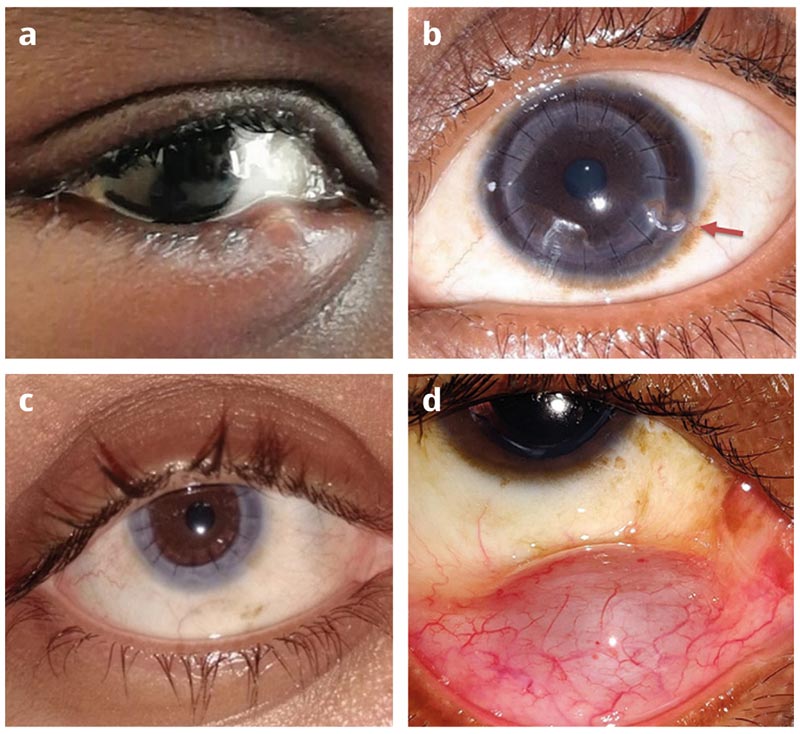 Four separate images of patient eyes with different conditions