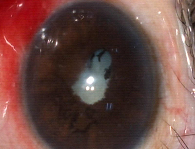 Close-up image of an eye with uveitis
