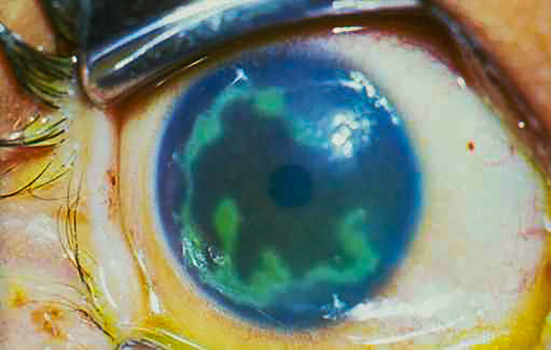Photographie en gros plan d’un œil après coloration à la fluorescéine, dont il faut deviner le diagnostic.