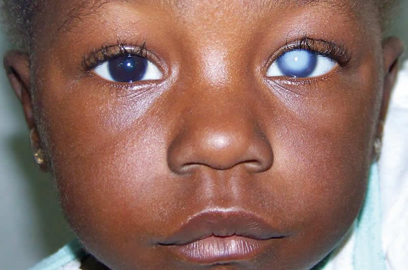 Enfant présentant une cicatrice cornéenne. GAMBIE. © Cheryl Madeira-Cole, Cheryl.Madeira-Cole@wales.nhs.uk