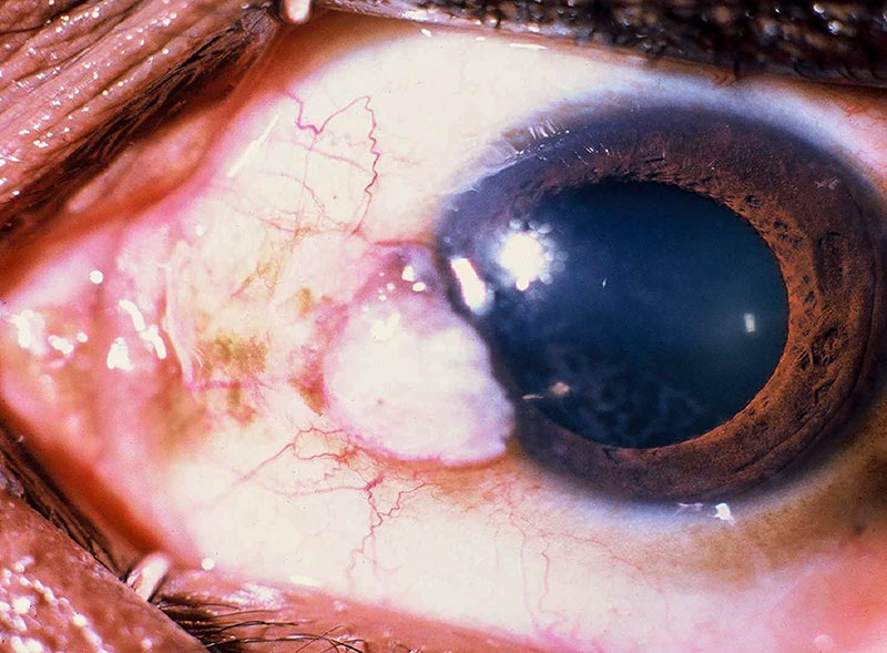 Photographie en gros plan d’un œil présentant un carcinome épidermoïde de la conjonctive.